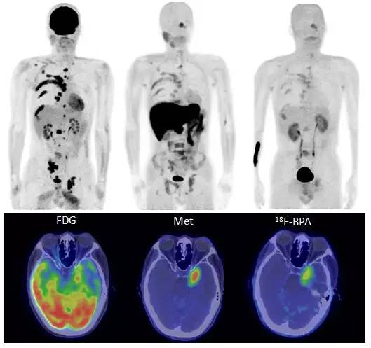 硼中子俘获疗法（BNCT）的“治癌黑科技”