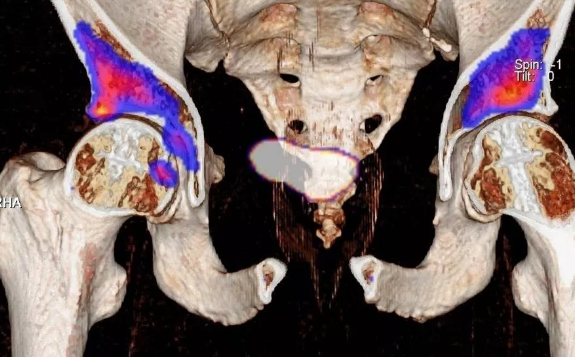 核医学新技术，让骨关节疾病“无所遁行”