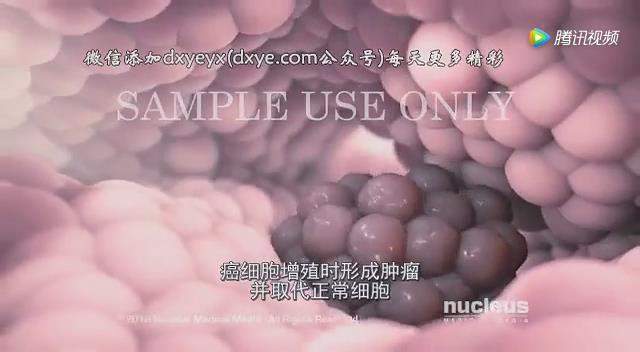 癌症治疗-IMRT（放射治疗）【中文字幕动画演示】