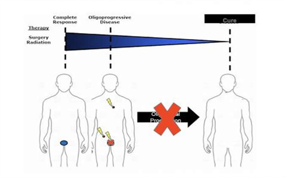 立体定向消融放射可能会减缓已扩散前列腺癌患者的病情进展
