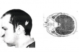 把头伸进粒子加速器那个人现在怎么样了?