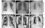 使用肺部X射线诊断COVID-19