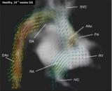 MR技术新方法首次以4D方式显示胎儿心脏