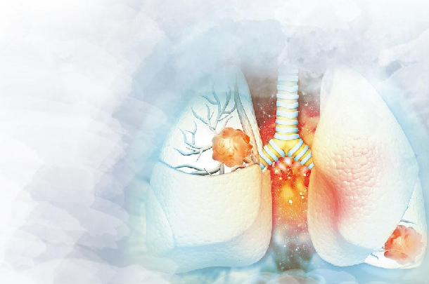 香港立体定位放射治疗控制早期肺癌率可达90%以上