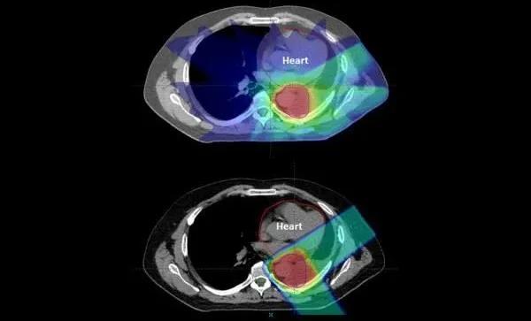 宾夕法尼亚大学最新研究成果：质子治疗肺癌在降低心脏剂量效应方面优于光子调强放疗
