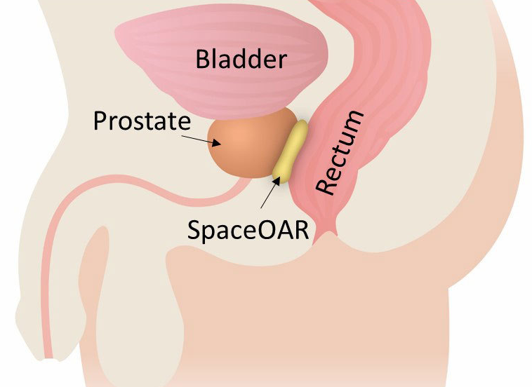 波士顿科学公司为前列腺癌患者推出减少放射副作用的产品