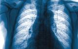 借助人工智能的胸部X光片可捕获更多肺癌