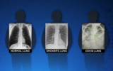 X射线图像显示新冠患者的肺部成像比吸烟者的肺部更糟糕 