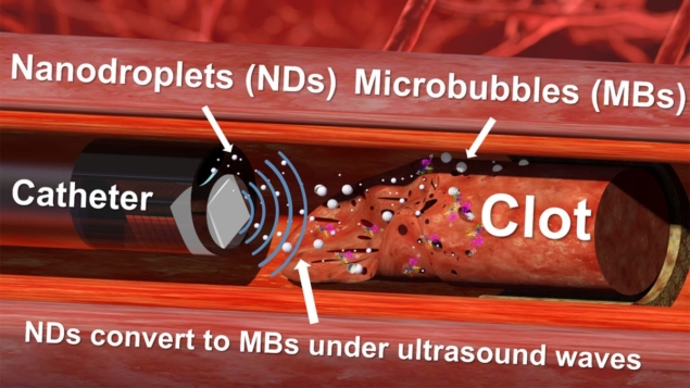 血栓治疗新突破：“超声钻”和纳米液滴可分解血块