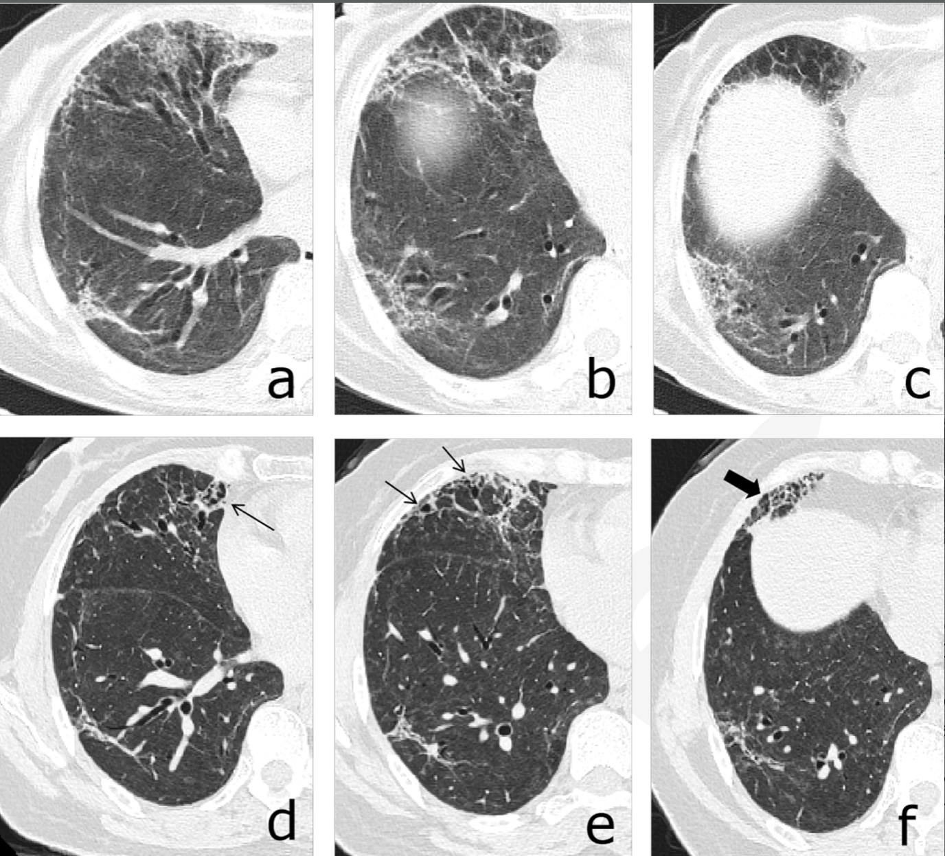 特发性肺纤维化 - NEJM医学前沿