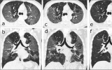 CT显示三分之一的新冠肺炎患者可能终生肺部损伤