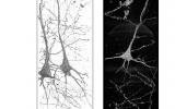 强大的X射线揭示了精神分裂症患者神经元的独特差异