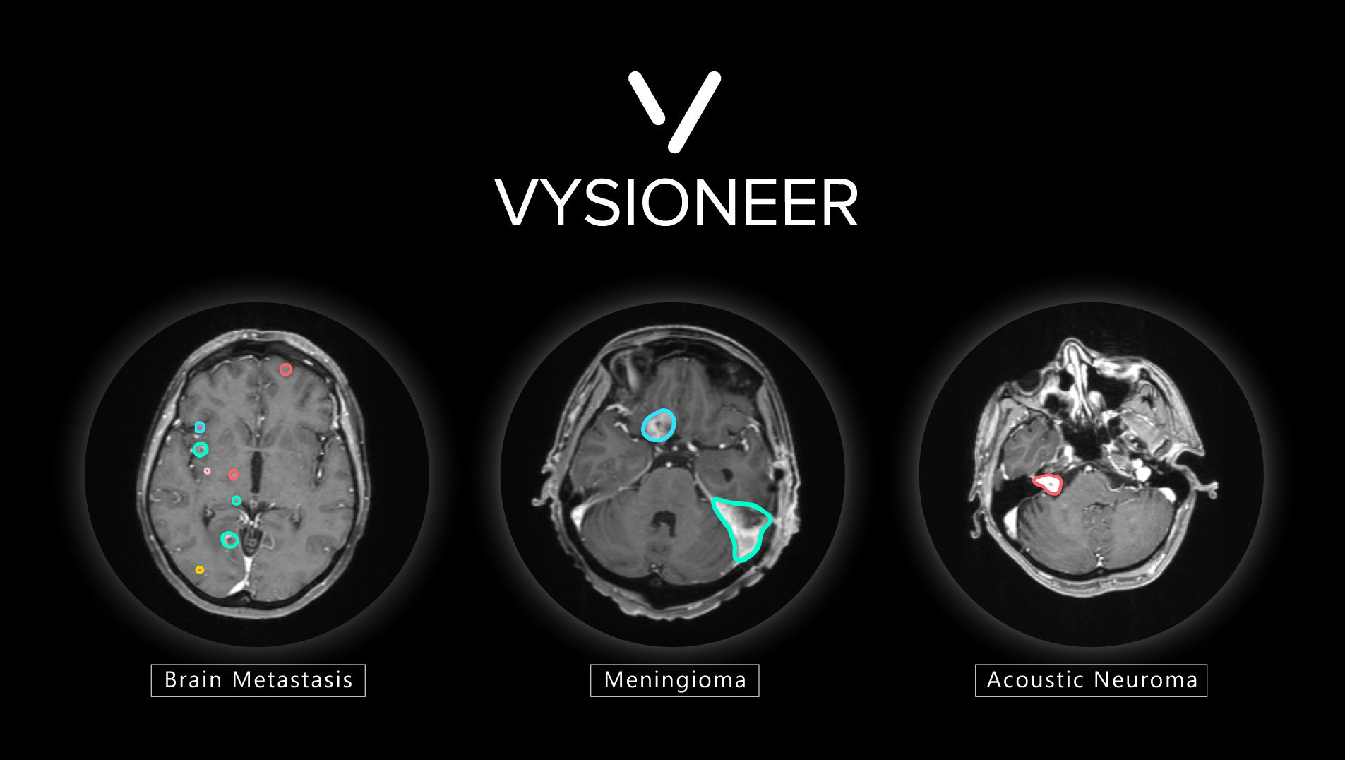 AI驱动的肿瘤自动轮廓解决方案VBrain获得FDA批准