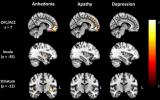 <p>核磁共振成像显示，年轻痴呆症患者的大脑奖赏回路退化</p>
