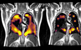 新成像技术可帮助发现长期新冠患者的隐性肺损伤