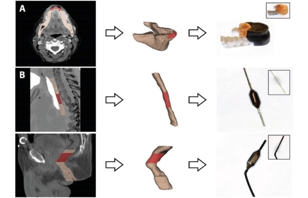 个性化3D打印防护罩在放射治疗期间保护健康组织