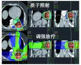 什么是质子治疗?