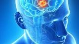 PET/MRI + 放射性药物可识别恶性脑肿瘤