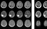 便携式MRI能以极低的成本实现对脑部疾病的检测