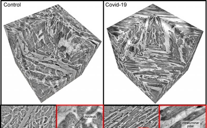 创新X射线成像技术能直接显示出新冠导致的心脏血管损伤