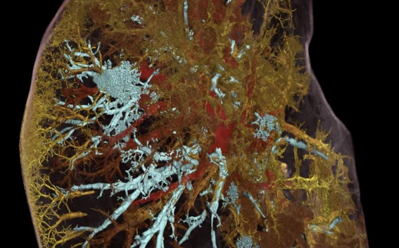 新型断层扫描技术：超强X射线揭秘新冠肺部损伤