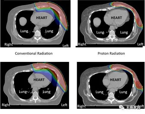 图 传统光子疗法(左)与质子疗法(右)的放射范围对比  注：红色：高辐射剂量;绿色：中间辐射剂量;蓝色：低辐射剂量