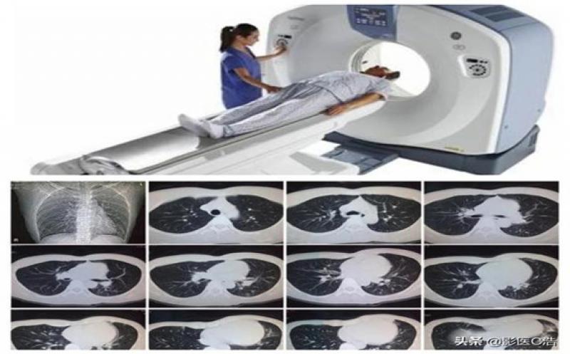CT扫描现在更广泛地用于早期检测肺癌