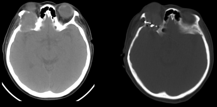 眼眶后方转移病灶植入前后CT图像对比