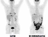晚期肺癌精准诊疗，PET/CT立功