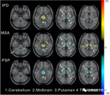 复旦华山管一晖/左传涛教授团队等《基于深度代谢成像指标进行帕金森综合征的鉴别诊断》研究论文被JNM在线发表