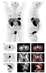 PET/CT下，良性前列腺增生摄取68Ga-DOTATATE