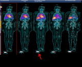 核技术下精准定量SPECT: The Time is NOW