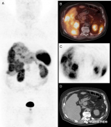 李锋：68Ga-DOTANOC PET/CT发现多灶性肝细胞癌