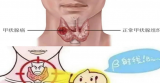刘超：放射性核素碘-131治疗的甲癌患者心理疏导 