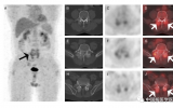 张瑞国：一例痛风石假性痛风18F-FDG PET/CT显像  