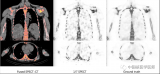 上海市东方医院与影动医疗共同研发人工智能7倍速超快SPECT骨成像方法