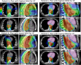 欧洲多中心食管癌III期随机对照临床试验比较质子与光子治疗计划的鲁棒性 