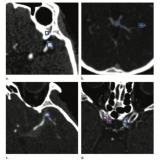 RSNA 的“放射学”期刊影响因子几乎增加了三倍