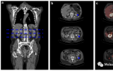 PET/CT核医学分子影像，EJNMMI|[68Ga]Ga-FAPI 摄取与慢性肾病的进展相关