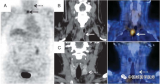 李周雷：FDG PET误诊食管癌的异位乳头状甲状腺癌的病例报道
