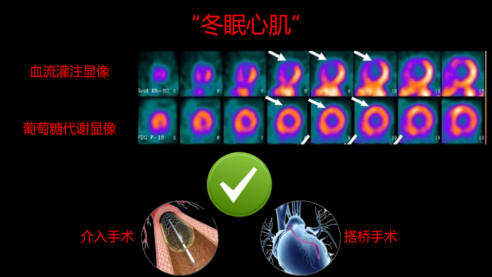 朱元凯，成钊汀，朱小华：《“洞若观火”—— 核医学显像洞见心肌的“黑洞”》