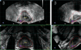 试验显示，新的成像技术在检测前列腺癌方面不如MRI准确