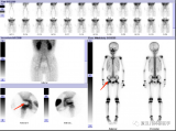 儿童骨骼照妖镜——核素全身骨显像