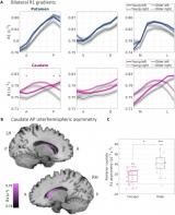 研究：改进后的核磁共振成像技术检测出帕金森病的早期症状