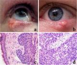 苏州医工所高欣团队提出智能化眼睑肿瘤病理鉴别新方法，还需放疗、化疗和靶向治疗等辅助治疗