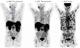 武萍、徐丽：18F-FDG 和68Ga-DOTATATE PET/CT在转移性胰腺神经内分泌肿瘤“超级影像”