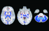 JAMA子刊：进行核磁共振扫描,大脑铁积聚增加了男性患运动障碍的风险