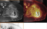 PET/MRI有望诊断慢性骨髓炎