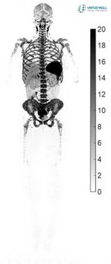 全身PET图像揭示人体对COVID的免疫反应