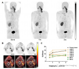 JNM|新型环肽放射性探针68Ga-FAP-2286在多种实体瘤中的PET/CT显像研究